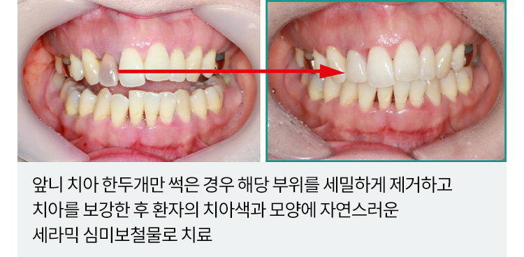 앞니 치아 한두개만 썩은 경우 해당 부위를 세밀하게 제거하고 치아를 보강한 후 환자의 치아색과 모양에 자연스러운 세라믹 심미보철물로 치료