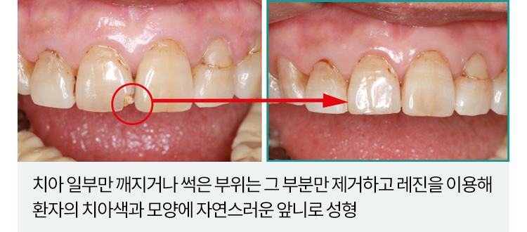 치아 일부만 깨지거나 썩은 부위는 그 부분만 제거하고 레진을 이용해 환자의 치아색과 모양에 자연스러운 앞니로 성형