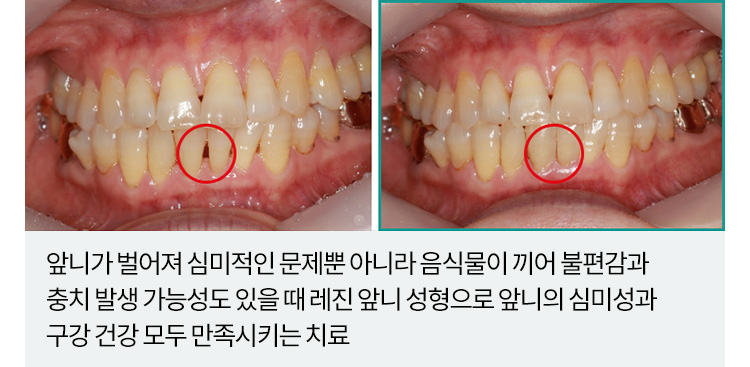앞니가 벌어져 심미적인 문제뿐 아니라 음식물이 끼어 불편감과 충치 발생 가능성도 있을 때 레진 앞니 성형으로 앞니의 심미성과 구강 건강 모두 만족시키는 치료