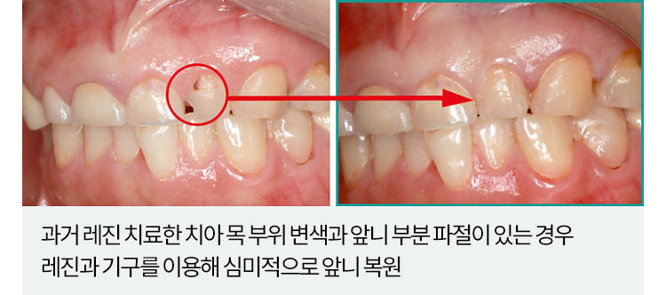 과거 레진 치료한 치아 목 부위 변색과 앞니 부분 파절이 있는 경우 레진과 기구를 이용해 심미적으로 앞니 복원