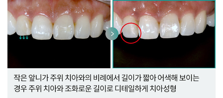 작은 앞니가 주위 치아와의 비례에서 길이가 짧아 어색해 보이는 경우 주위 치아와 조화로운 길이로 디테일하게 치아성형