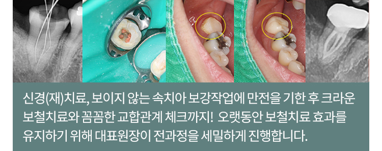 신경(재)치료, 보이지 않는 속치아 보강작업에 만전을 기한 후 크라운 보철치료와 꼼꼼한 교합관계 체크까지! 오랫동안 보철치료 효괄르 유지하기 위해 대표원장이 전 과정을 세밀하게 진행합니다.