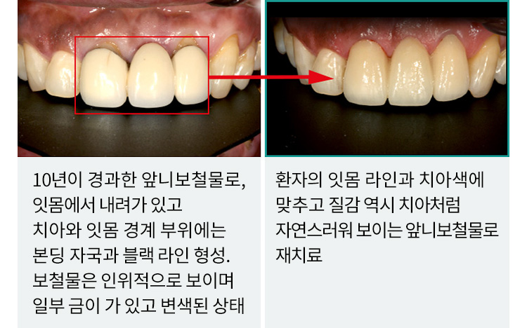 10년이 경과한 앞니보철물로, 잇몸에서 내려가 있고 치아와 잇몸 경계 부위에는 본딩 자국과 블랙 라인 형성. 보철물은 인위적으로 보이며 일부 금이 가 있고 변색된 상태 / 환자의 잇몸 라인과 치아색에 맞추고 질감 역시 치아처럼 자연스러워 보이는 앞니보철물로 재치료