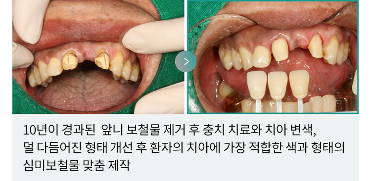 10년이 경과된 앞니 보철물 제거 후 충치 치료와 치아 변색, 덜 다듬어진 형태 개선 후 환자의 치아에 가장 적합한 색과 형태의 심미보철물 맞춤 제작
