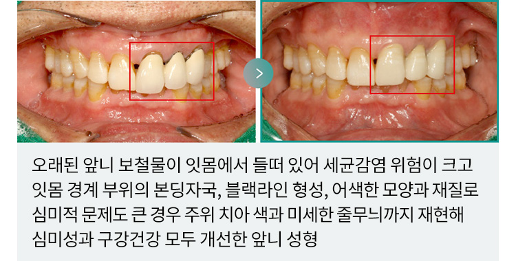 오래된 앞니 보철물이 잇몸에서 들떠 있어 세균감염 위험이 크고 잇몸 경계 부위의 본딩자국, 블랙라인 형성, 어색한 모양과 재질로 심미적 문제도 큰 경우 주위 치아 색과 미세한 줄무늬까지 재현해 심미성과 구강건강 모두 개선한 앞니 성형