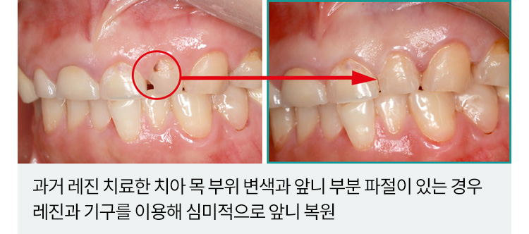 과거 레진 치료한 치아 목 부위 변색과 앞니 부분 파절이 있는 경우 레진과 기구를 이용해 심미적으로 앞니 복원