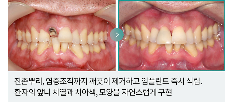 잔존뿌리, 염증조직까지 깨끗이 제거하고 임플란트 즉시 식립. 환자의 앞니 치열과 치아색, 모양을 자연스럽게 구현