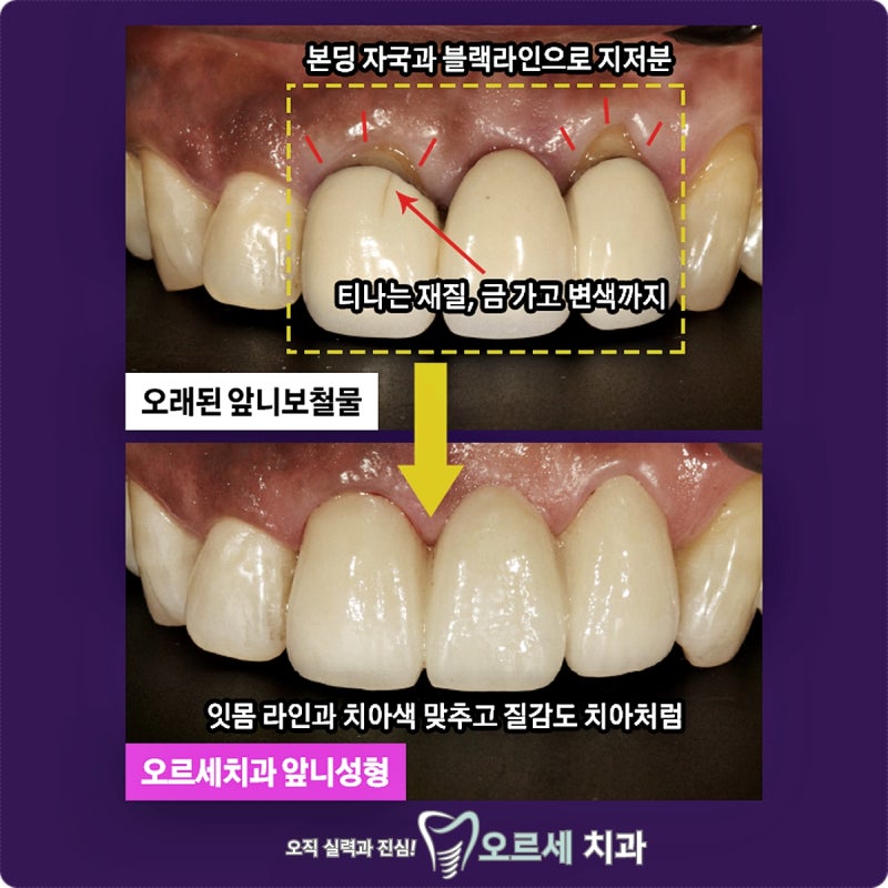 강남역에서 치과 레진 가격 고민될 때… 썸네일