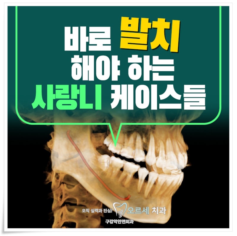 사랑니 두통 오직 발치만이 해결 방법… 썸네일